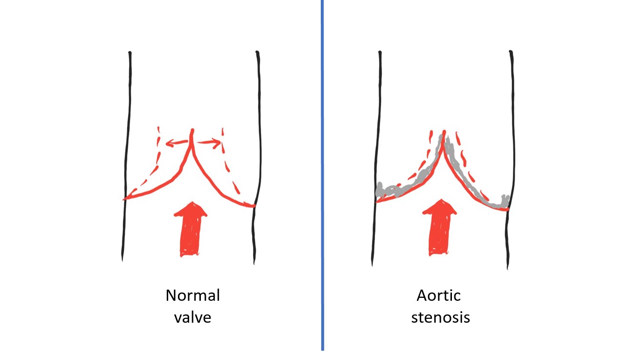 Figure 3: Normal versus restricted opening of the valve