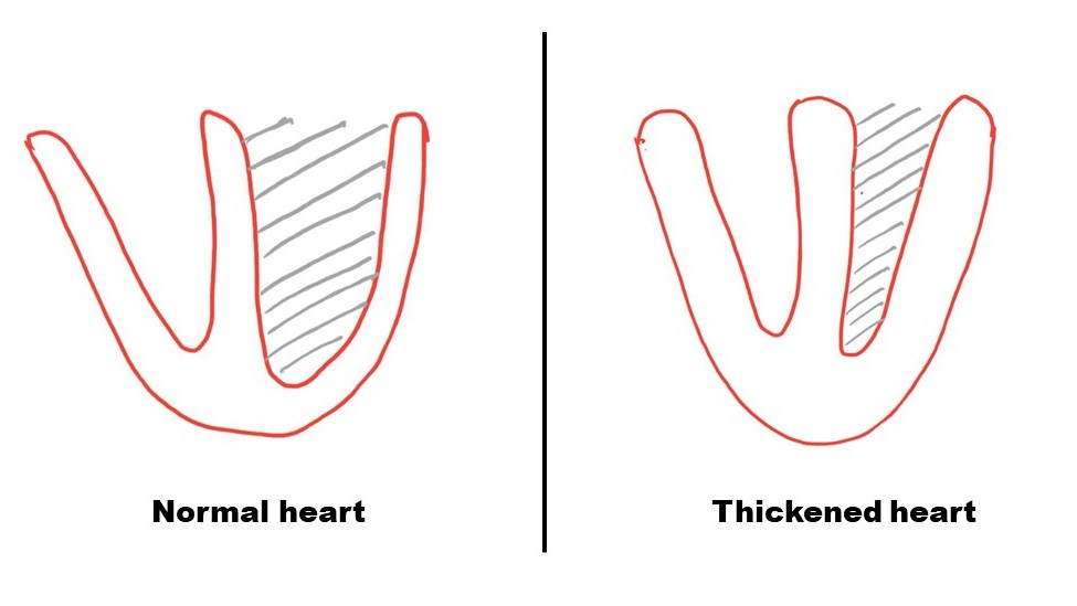 Figure 3: Thickened heart does not relax fully to accept the blood. This causes backup of pressure in the entire system.