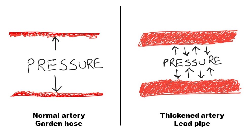 Figure 1: High pressure causes arteries to become thick, inflexible and in-expansible. 