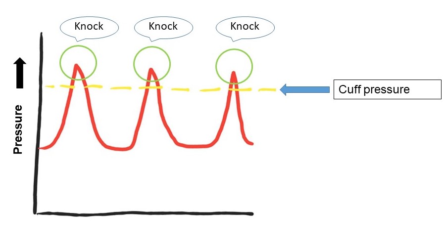 Figure 3: Knocking sound heard with each heart-beat