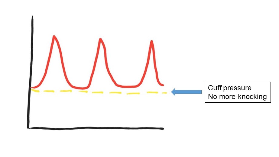 Figure 4: As cuff pressure drops below the diastolic pressure, the knocking sound stops