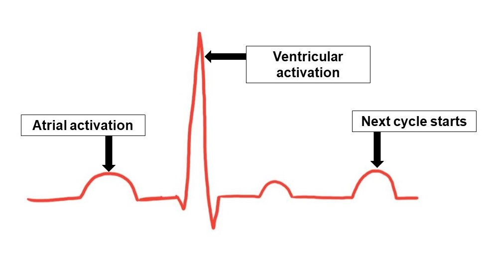 Figure 3: Atrial activation followed by ventricular activation depicted on a lead of an ECG 