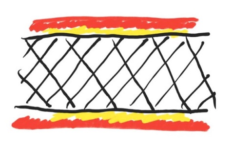 Figure 3: A stent is placed across the stretched blockage