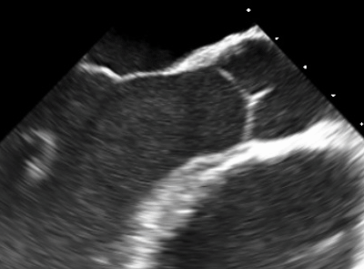Figure 2: Aortic valve is made of a thin flap of tissue